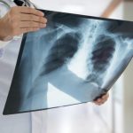 aktinografia-stithous-chest-xray-st.jpg