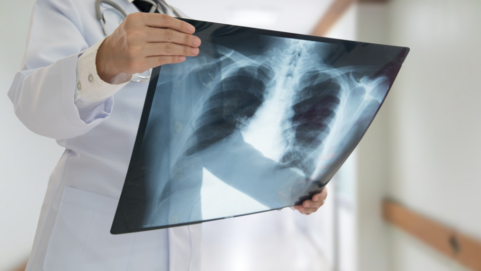 aktinografia-stithous-chest-xray-st.jpg